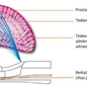 Fokal Tedavi - Prof. Dr. Can Öbek